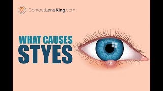 What Are Styes Causes Symptoms and Treatments [upl. by Bohner154]