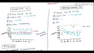 Conductive and Sensorineural Hearing Loss Deafness for USMLE [upl. by Nehr]