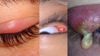 What is an Internal Stye [upl. by Nanaj]