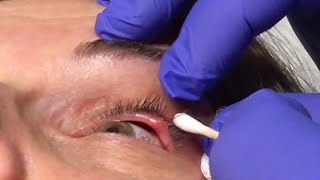 Surgeon Drains Stye On Womans Eye [upl. by Constance732]