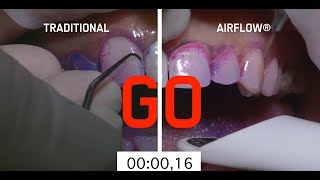 Abrasive teeth cleaning method vs AIRFLOW method [upl. by Sillad331]