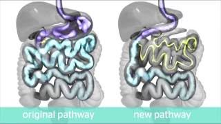 Evolution® Duodenal ControlledRelease Stent  Uncovered Animation [upl. by Pippo]