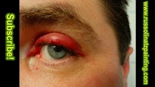 Chalazion Surgery [upl. by Namdor]