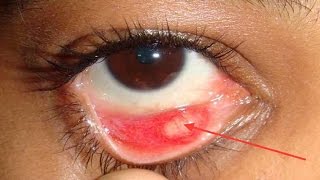 How To Get Rid Of A Stye In Your Eye [upl. by Ekalb46]