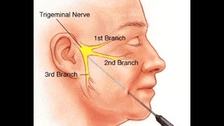 Trigeminal Neuralgia [upl. by Gunning]