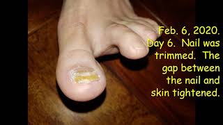 Fenben v Fungal Nail an Experimental Treatment of Fungal Nail with Fenben [upl. by Eniamurt]