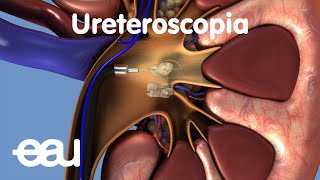 Tratamiento de cálculos renales y ureterales URS [upl. by Ardnassak]