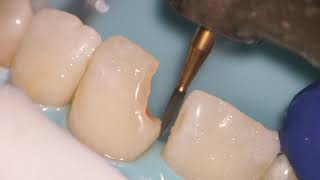 Teeth Bonding  Front tooth filling EXPLAINED [upl. by Eb]