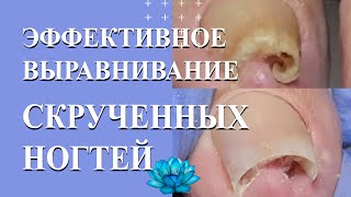 Грибок на пальцах ног Онихомикоз ногтей [upl. by Akehs]