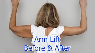 Brachioplasty arm lift things you should know [upl. by Chally]