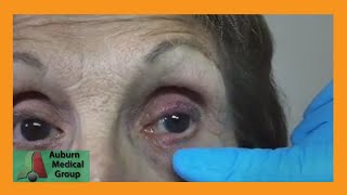 A Stye and a Chalazion  Auburn Medical Group [upl. by Butterworth]