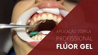 Aplicação Tópica Profissional de Flúor Gel ATF [upl. by Cassella]