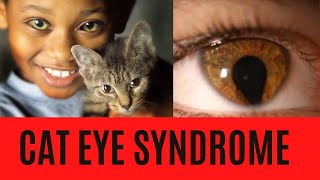 CAT EYE SYNDROME SummarySymptomsSignsCausesTreatmentDiagnosisPrognosis [upl. by Oiretule]