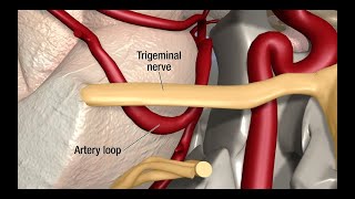 Treatment for Trigeminal Neuralgia UCSF Neurosurgery [upl. by Namien]