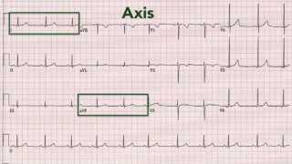 ECG interpretation recognising normal [upl. by Ynohtnacram]