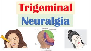 Trigeminal Neuralgia “Severe Facial Pain” Causes Pathophysiology Symptoms Diagnosis Treatment [upl. by Annet910]