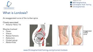 Lordosis Treatment A 3 Step Process [upl. by Zeitler]