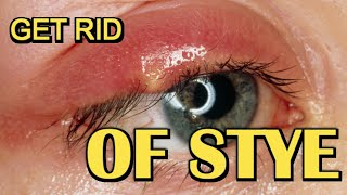 How To Get Rid Of Stye Fast  Removal At Home [upl. by Bodi686]