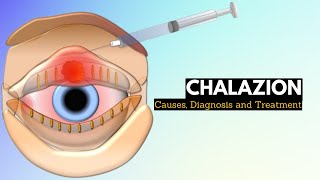 CHALAZION Causes Signs and Symptoms Diagnosis and Treatment [upl. by Eissen]