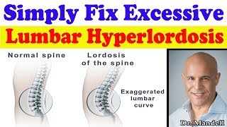 Simply Fix Excessive Lumbar Hyperlordosis  Dr Alan Mandell DC [upl. by Tigges]