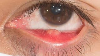 Eye Cysts What is an Eye Stye [upl. by O'Brien842]